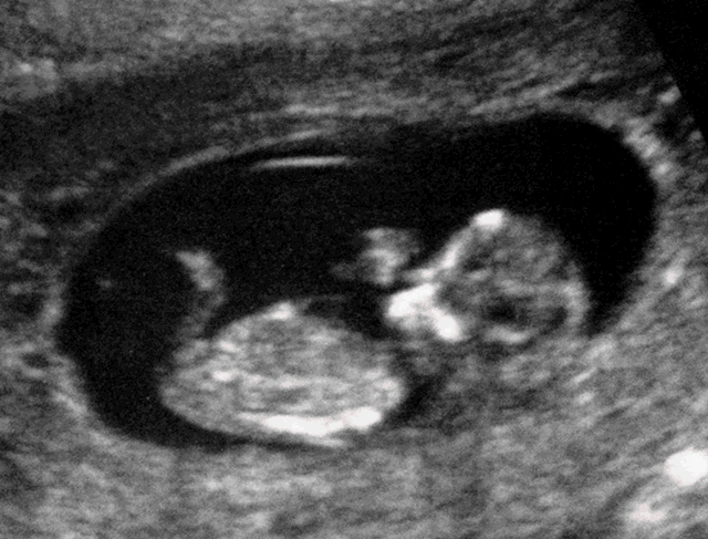 11 недель беременности фото узи плода