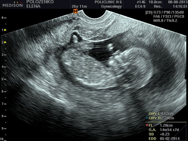 13 акушерская неделя. Снимки УЗИ на 13 неделе беременности. УЗИ 12-13 недель беременности. Как выглядит ребенок на УЗИ В 13 недель.