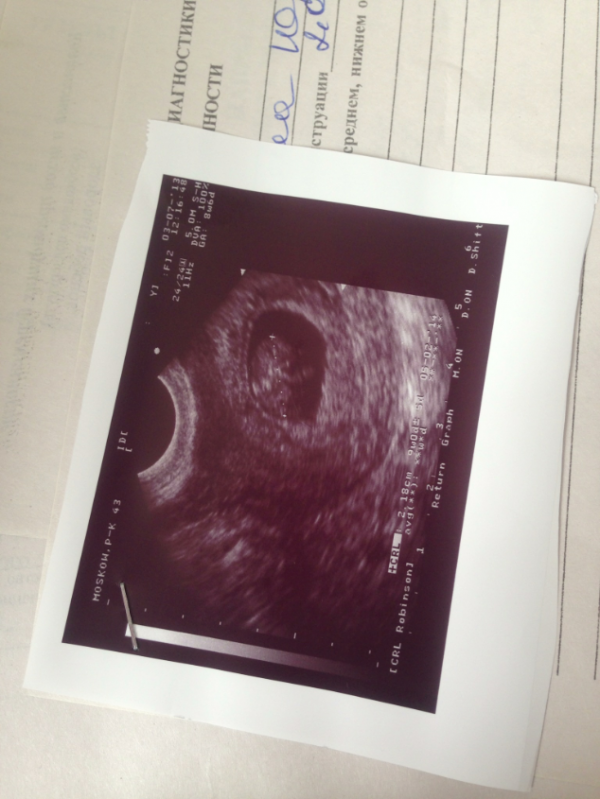Фото ребенка на 8 неделе беременности фото узи