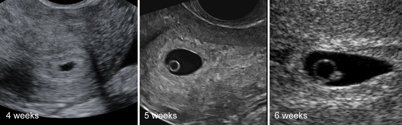 5 недель можно делать. 4 Эмбриональная неделя беременности УЗИ. Эмбрион на 5 неделе беременности УЗИ. Беременность 2-3 недели фото плода УЗИ. Эмбрион на 4 неделе беременности УЗИ.