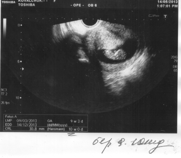 Фото узи в 9 недель беременности фото