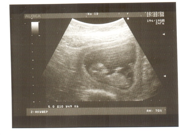 11 недель и 3 дня. УЗИ 11 недель беременности. 11 И 5 недель беременности УЗИ. Снимок УЗИ 11 недель. УЗИ на 11 акушерской неделе беременности.