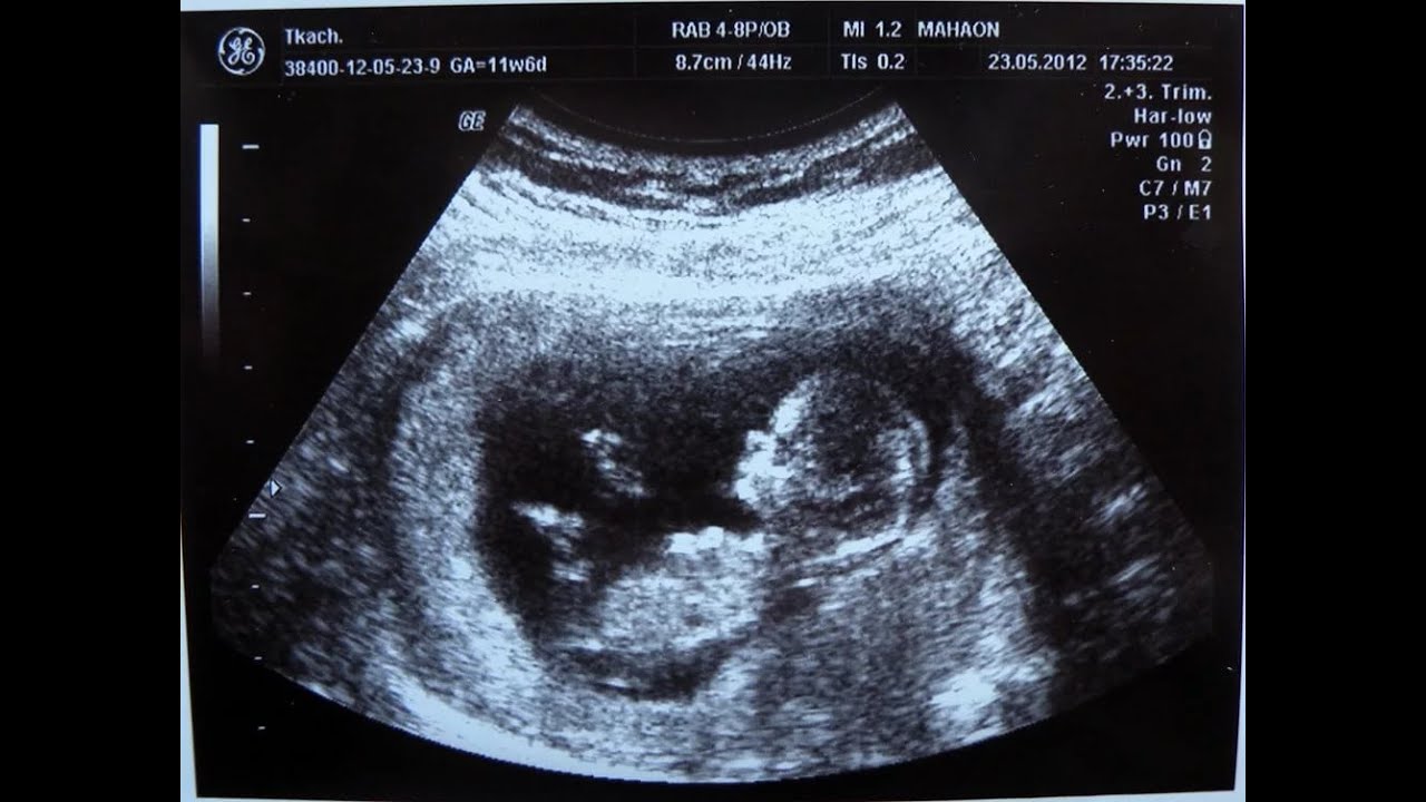Сколько будет 11 недель. УЗИ ребенка на 11 неделе беременности. УЗИ 9-10 недель беременности. УЗИ на 11 неделе беременности фото. Фото УЗИ беременности 10-11 недель.