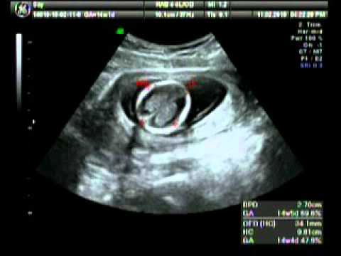 Сердцебиение 14 недель. УЗИ на 14 акушерской неделе беременности.