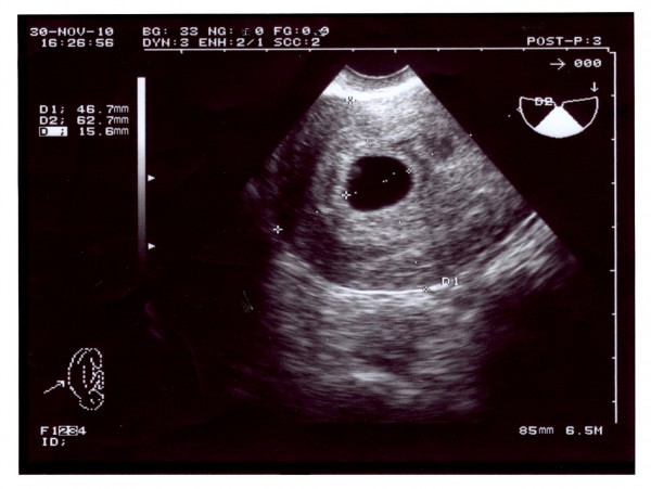 Фото узи на 5 неделе. 6 Акушерских недель беременности на УЗИ. Снимок УЗИ на 6 неделе беременности. Эмбрион 6 неделя снимок УЗИ.