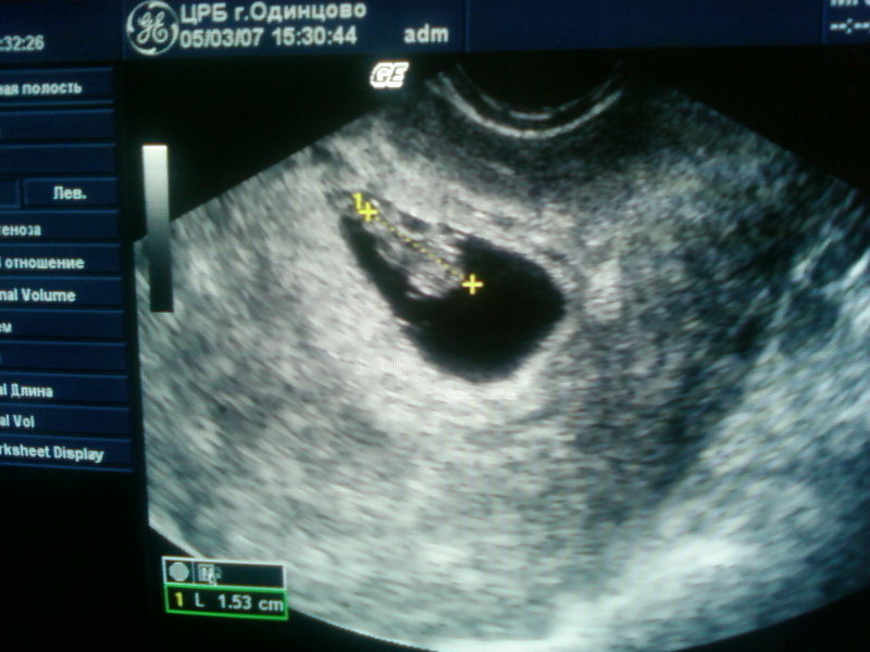 В течении 7 недель 8. 7 Недель беременности фото эмбриона. Беременность 7 недель фото эмбриона на УЗИ. Как выглядит плод на 7 неделе на УЗИ. Эмбрион на 7 неделе беременности УЗИ.