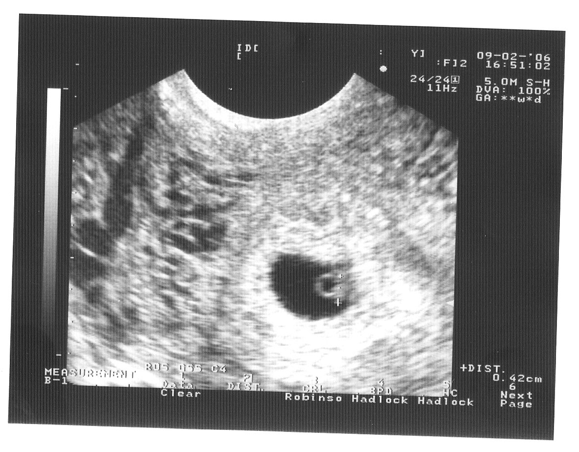 Как выглядит узи на 6 неделе. УЗИ 5-6 недель беременности. УЗИ 6.6 недель беременности. УЗИ 5 6 недель беременности фото УЗИ.