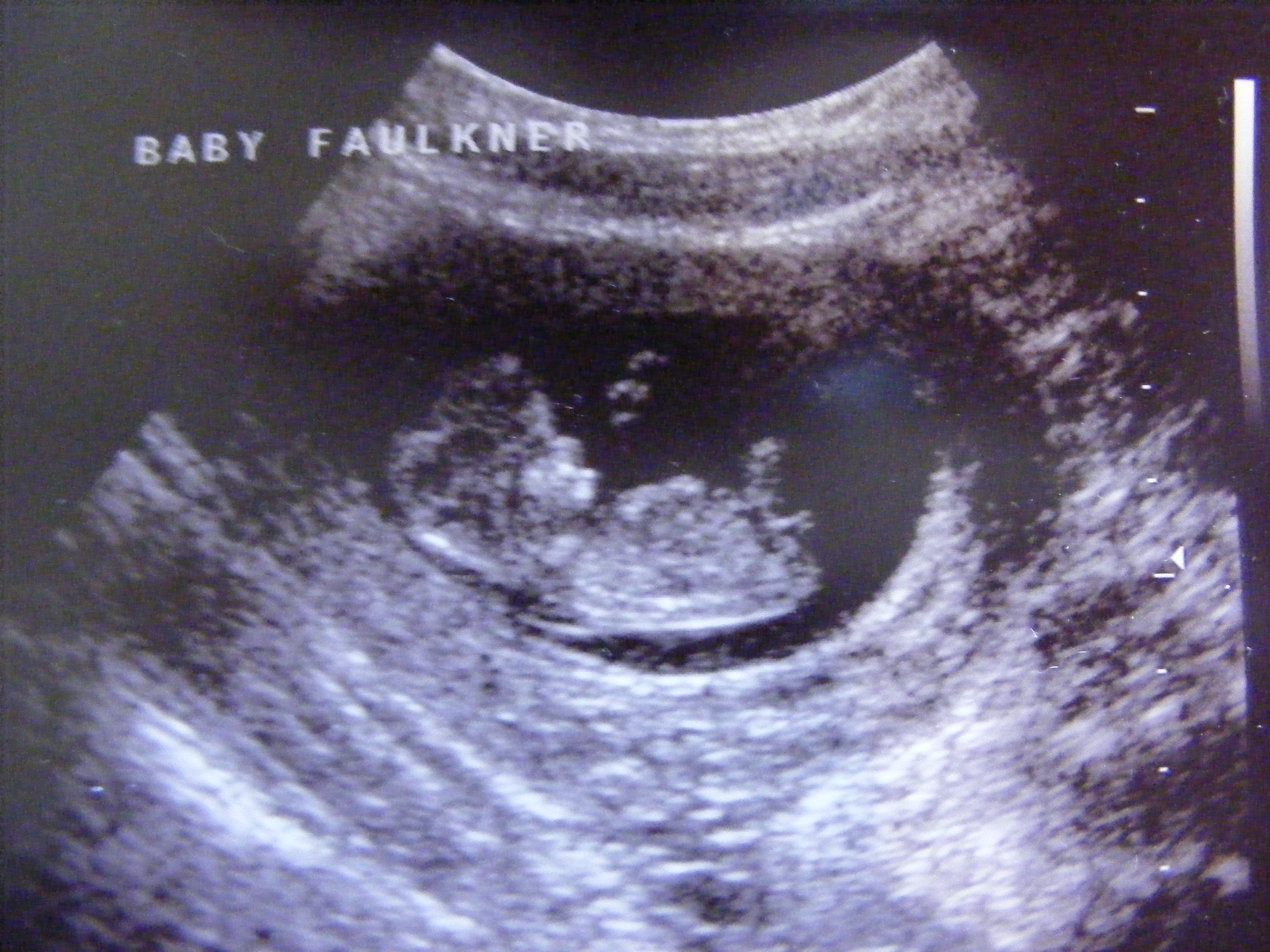 Шейка 6 недель. Эмбрион на 11 неделе беременности УЗИ. УЗИ 11 недель беременности. УЗИ ребенка на 8 неделе беременности. УЗИ 10 недель беременности.