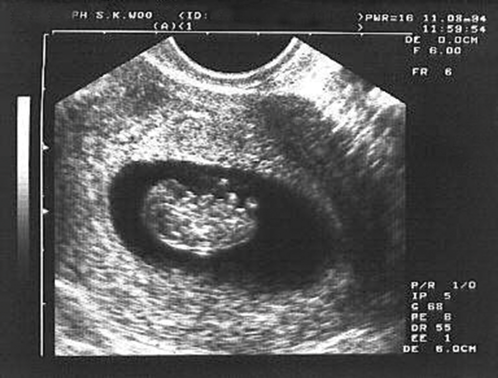 Состояния при 8 неделях. УЗИ на 8 неделе беременности акушерской. Эмбрион на 8 неделе беременности УЗИ. УЗИ 8.5 недель беременности. Фото УЗИ плода на 8 акушерской неделе беременности.