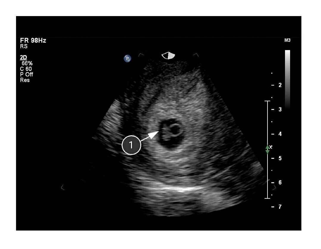 Узи при месячных. УЗИ плода на 3 неделе беременности от зачатия. Плод в 3 недели беременности на УЗИ.