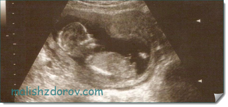 Как выглядит малыш на 13 неделе беременности фото